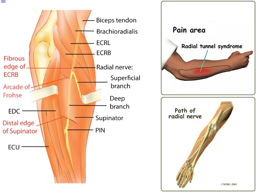 Figure 3 for case Radial tunnel syndrome